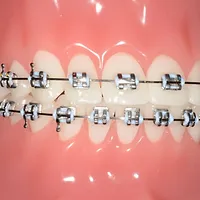 Nashville Braces, Franklin Invisalign, Brentwood TN Braces